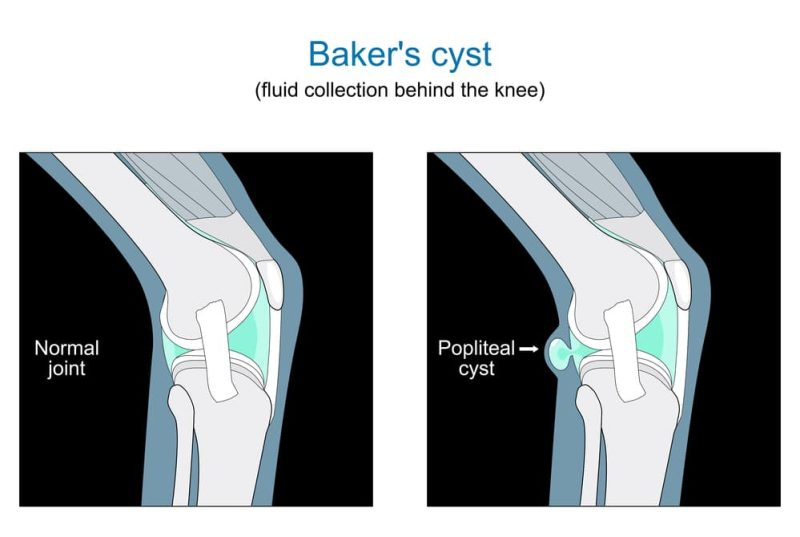 8 Best Ways to Treat Baker’s Cyst – my.DrugGenius